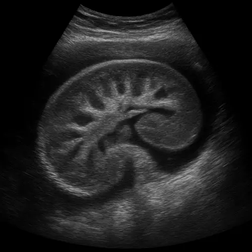 ultrasound method of imaging the kidneys, the typical shape and internal structure of a human kidney