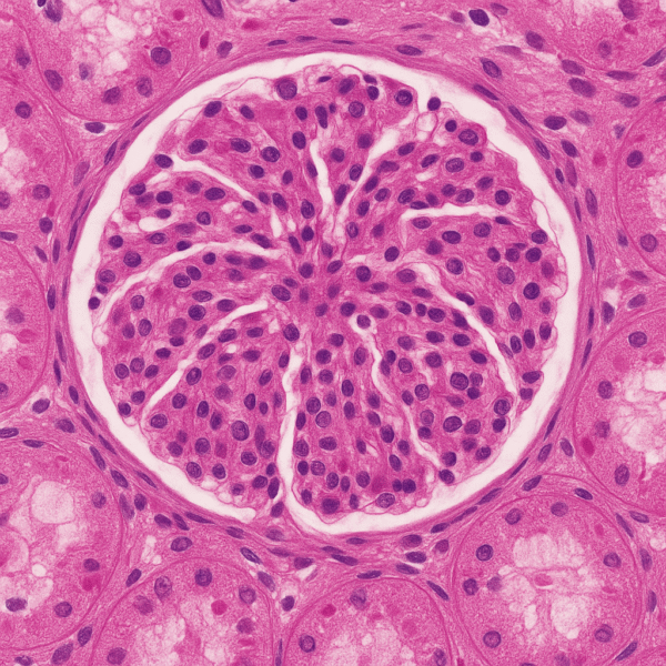 A glomerular tuft surrounded by renal tubules as seen on kidney biopsy specimens.