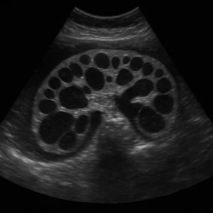 Polycystic kidney disease on ultrasound imaging the kidneys