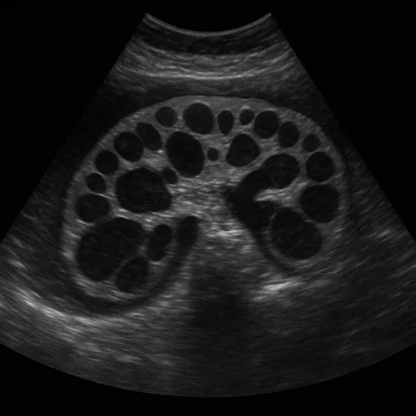Polycystic kidney disease on ultrasound imaging the kidneys
