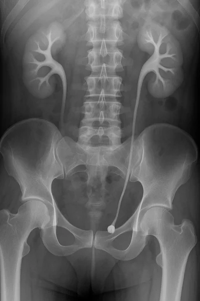 An IVP x-ray showing a UPJ obstruction from nephrolithiasis in metabolic stone disease